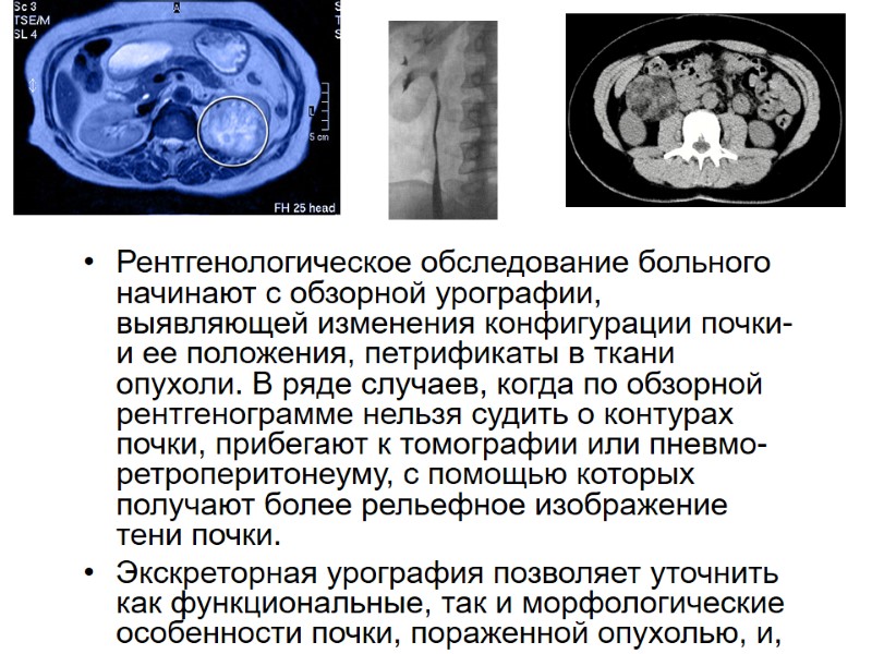 Рентгенологическое обследование больного начинают с обзорной урографии, выявляющей изменения конфигурации почки- и ее положения,